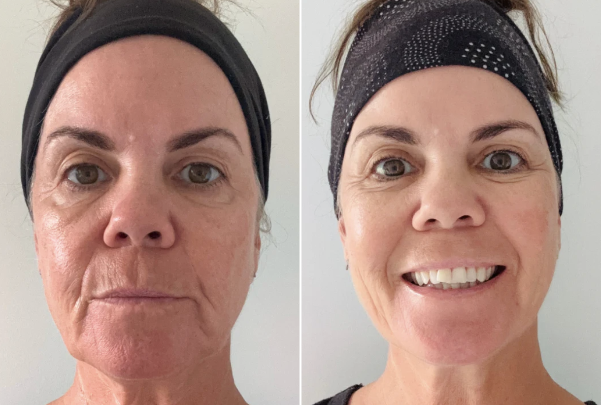 Before and after — Tone, firmness & glow