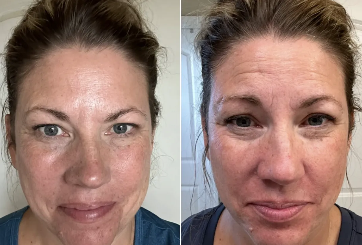 Before and after — Even tone & smoothness