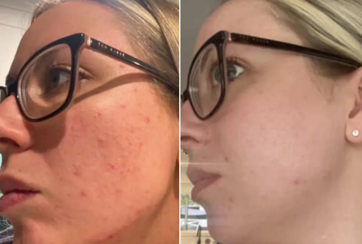 Before and after — Breakouts & clarity