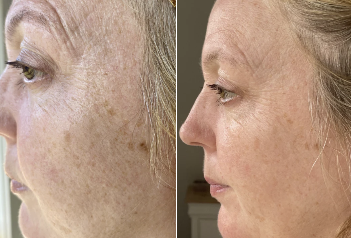 Before and after — Pigmentation & texture