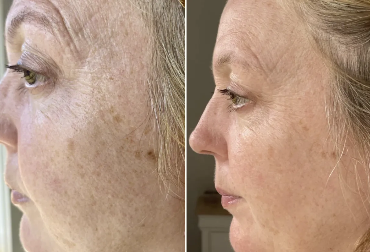 Before and after — Pigmentation & texture